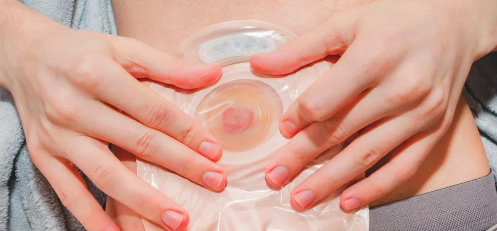 Stoma Suretech Ostomy designers